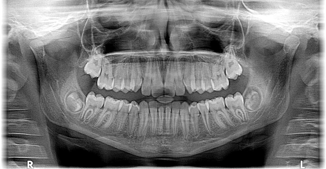 Invisalign Tedavisinin Tamamlanmasının Ardından Gülüşünüzdeki Değişiklikleri Kutlama Yolları