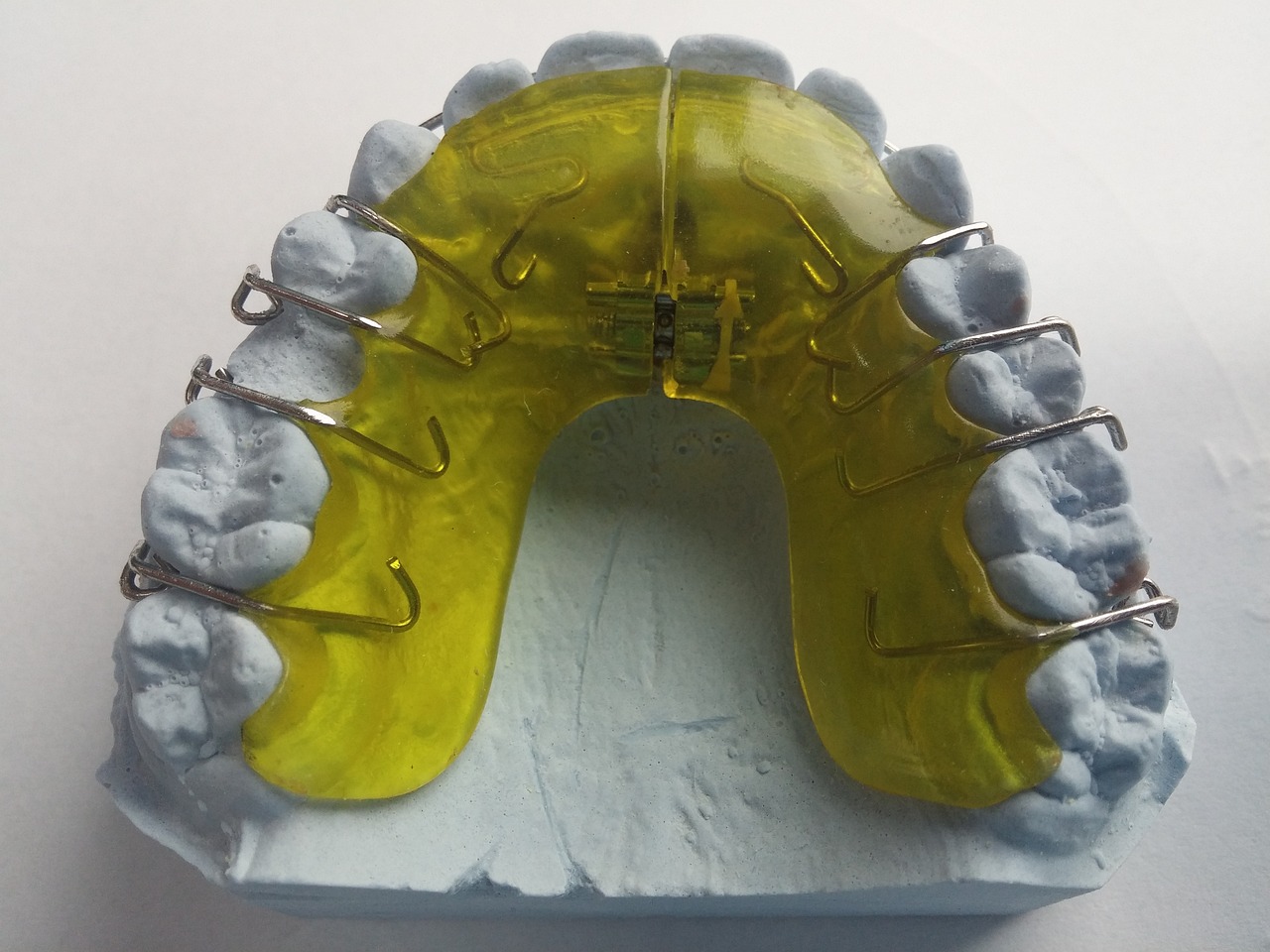 İnvisalign Tedavisi Planlamasında Dikkate Alınması Gereken Faktörlerİnvisalign, güzel bir gülüşe sahip olmanın modern bir yoludur. Ancak, planlama aşamasında, belirli faktörlerin dikkate alınması önemlidir.