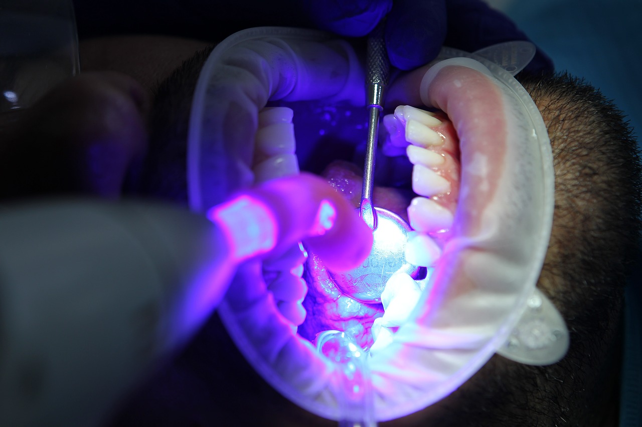 İnvisalign'in Çıkartılabilir Plakları ve Avantajları