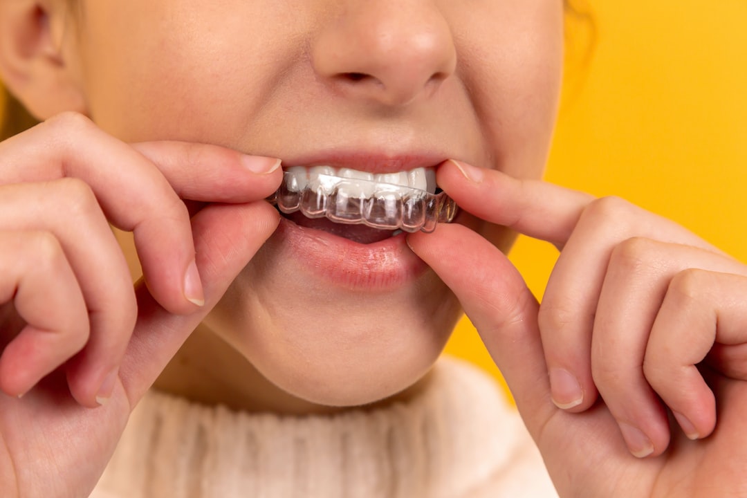 Diş Düzeltme için İdeal Seçenek: Invisalign mı, Porselen Tel mi?