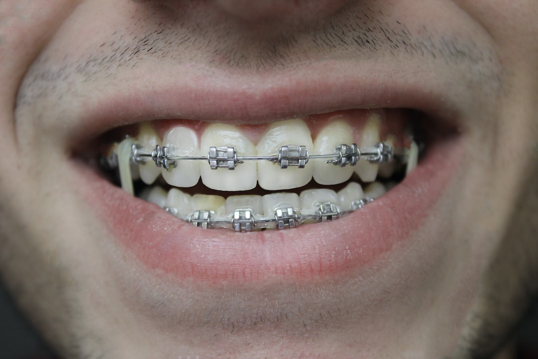 İnvisalign Tedavisi