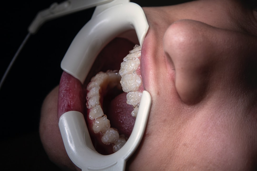 İnvisalign Tedavisinde İlk Plakları Alma 