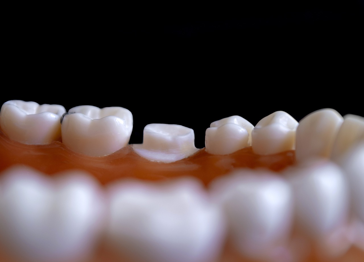 Invisalign Tedavisiyle Düzelen Dişler: Sonuçları Görmek