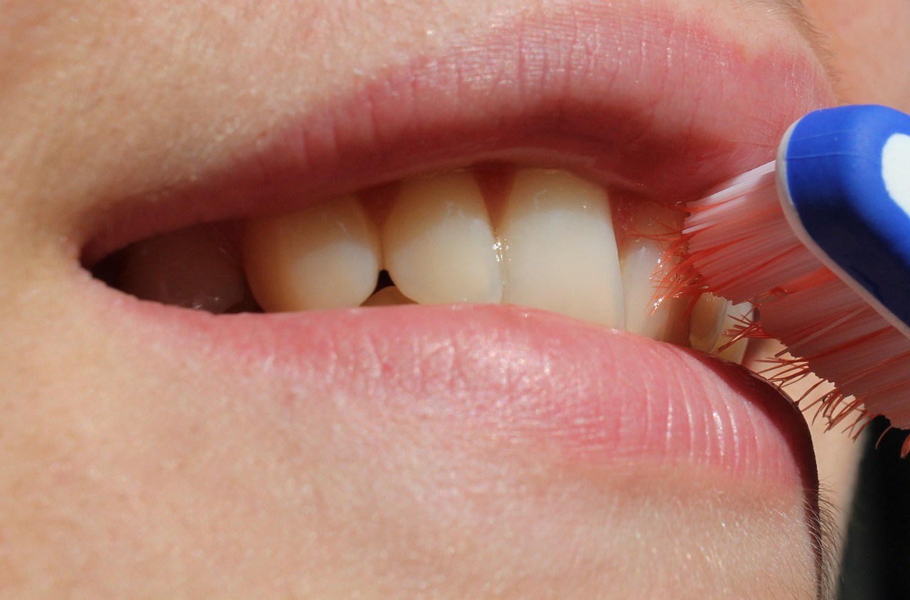 Invisalign Nedir?