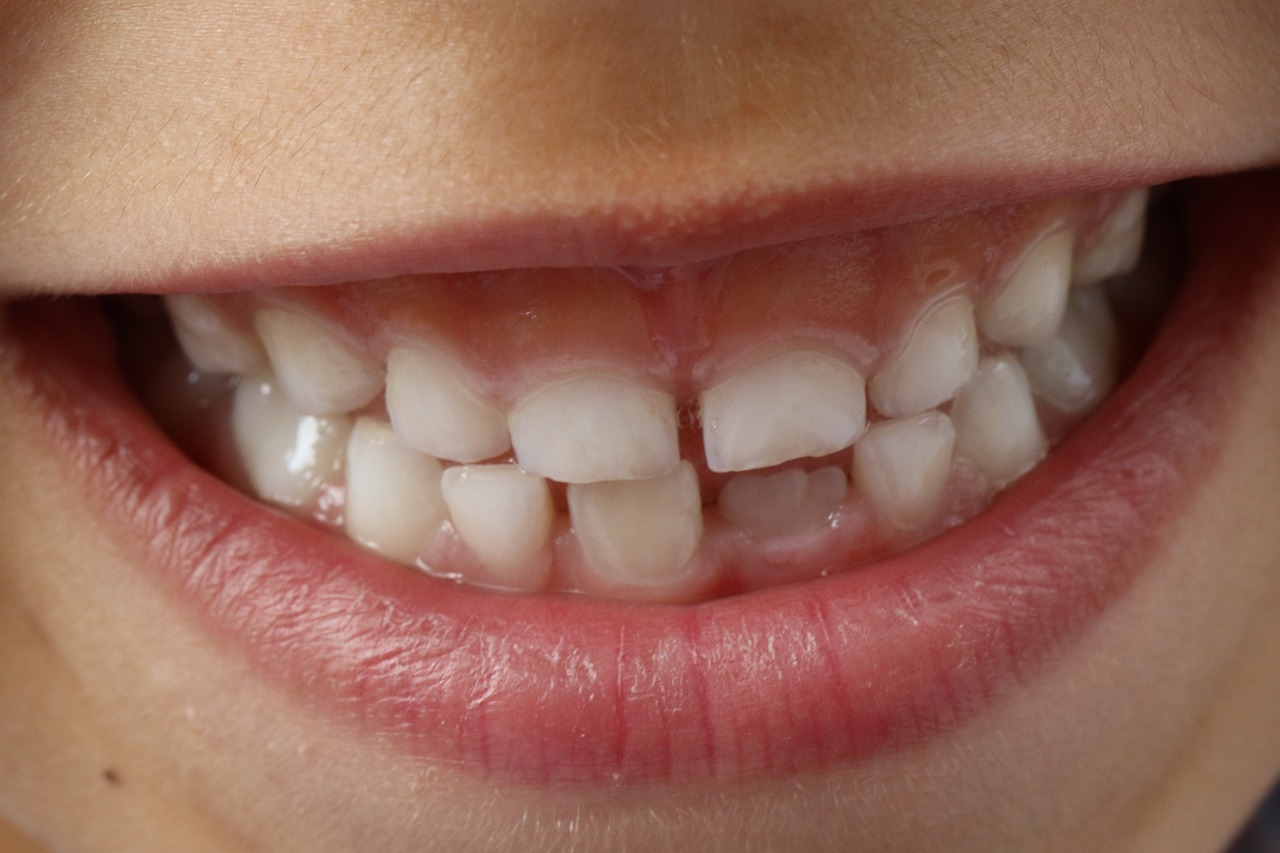 Invisalign Nedir?