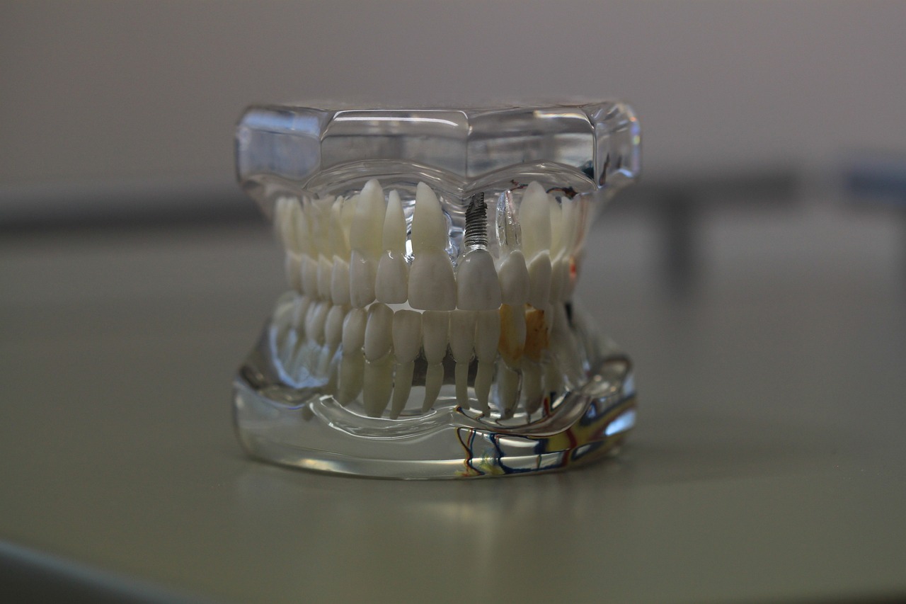 Invisalign veya Porselen Tel