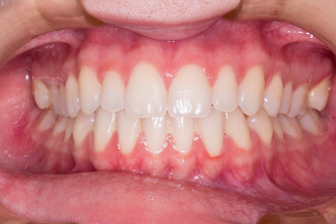 Invisalign vs. Şeffaf Tel Tedavisi: Konuşma ve Yutma Üzerindeki Etkiler Karşılaştırması (Yazının sonuna Sık Sorulan Sorular ekle)