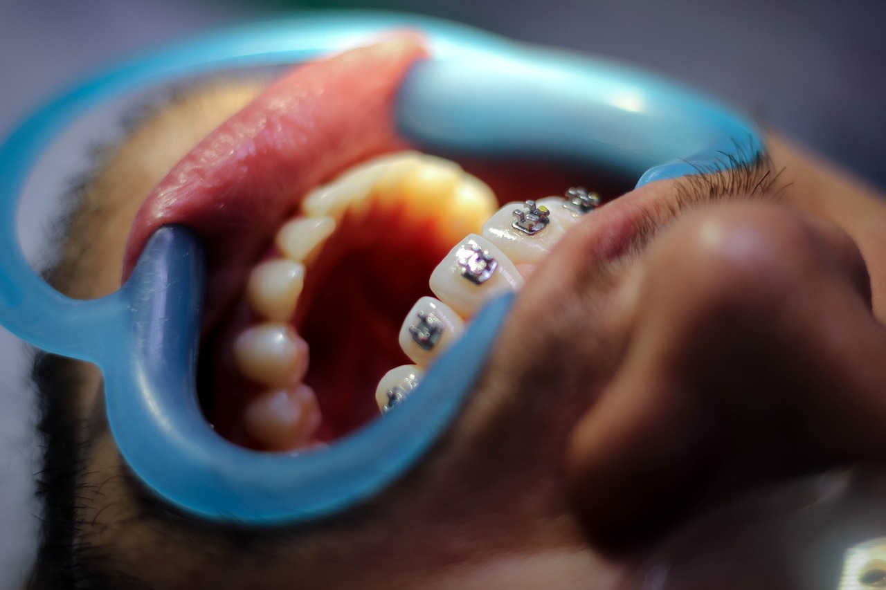 Invisalign Plaklarının Hijyenik Saklanması 